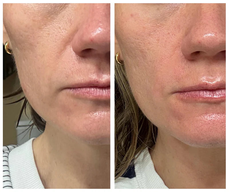 - 4% Retinal Liposome Facial Treatment